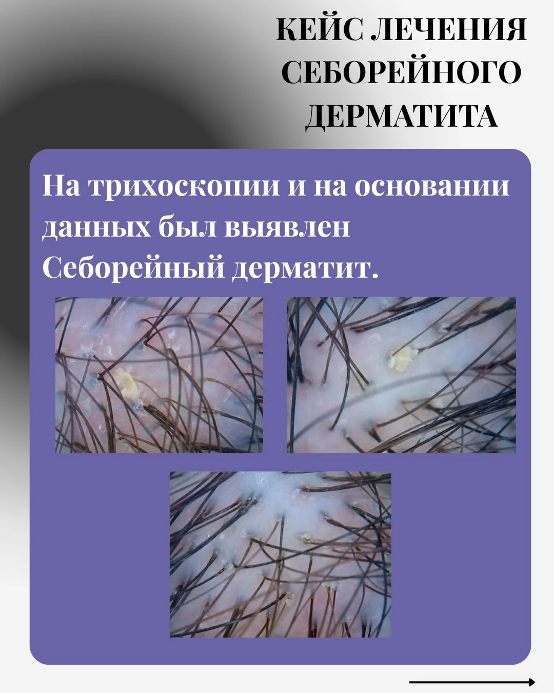 Скалпът под увеличение. Преди. Два оригинални слайда от една публикация — без промяна на изображенията.